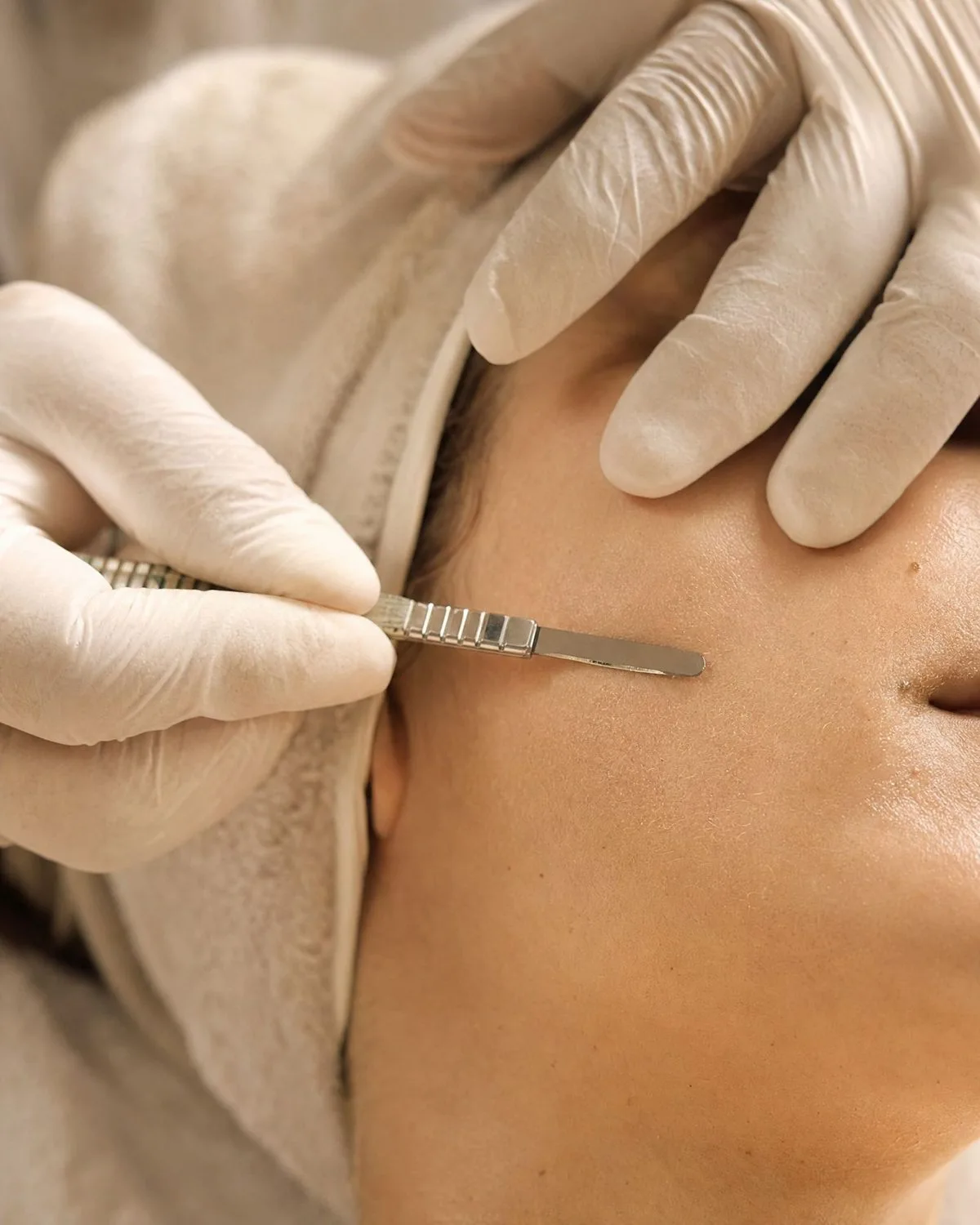 Esthetician dermaplaning a client's cheek with a fine blade